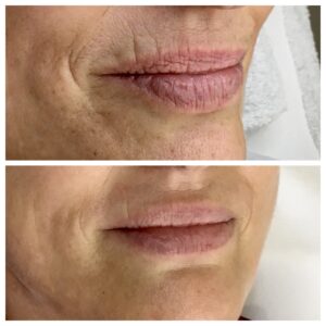 aumento de labios malaga