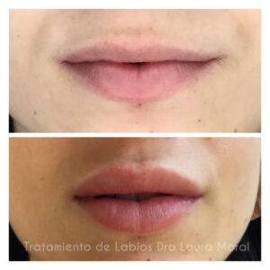 aumento-de-labios-antes-y-despues-2-300x300
