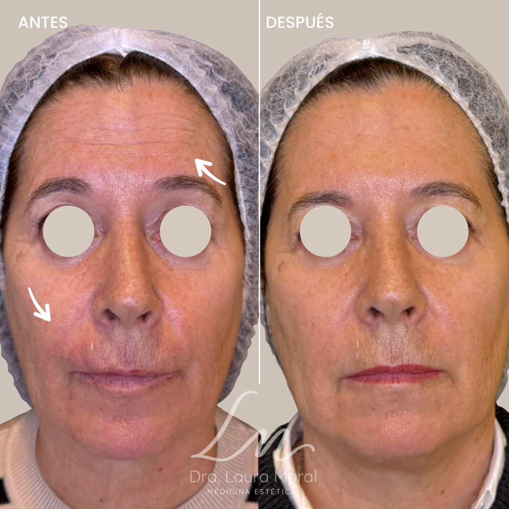 armonizacion facial malaga antes y despues