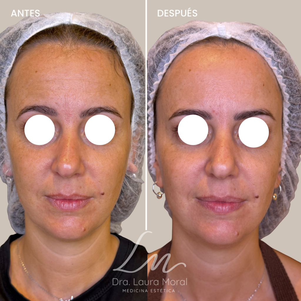 tratamiento armonizacion facial antes y despues